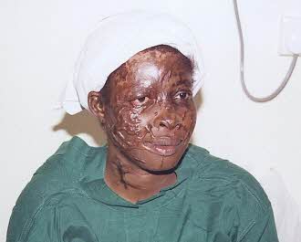 Example of a battery acid burn
